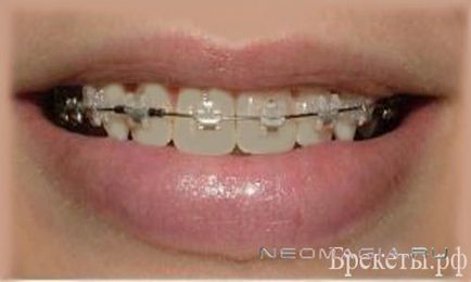 Braces in-ovation - promoții, fotografii înainte și după, prețuri, consultări, comentarii, forum despre plastic