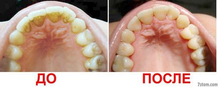 Curățarea dinților înainte de a instala bretele - stoc, înainte și după fotografie, prețuri, consultări, recenzii, forum