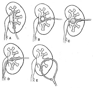 A perkután nephrostomia punkció (chpns)