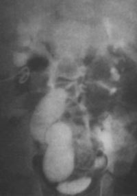 Nefrostomia punctiformă percutanată la sugari și copii mici - urologie chirurgicală -