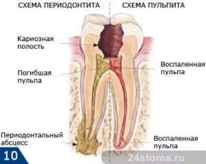 Ce trebuie să faceți dacă umfla gingiile dă, dinții