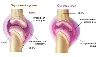 Що може показувати узі колінного суглоба