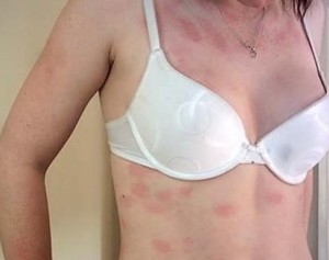Що викликає появу алергії на шкірі і як безпомилково визначити алергічне прояв