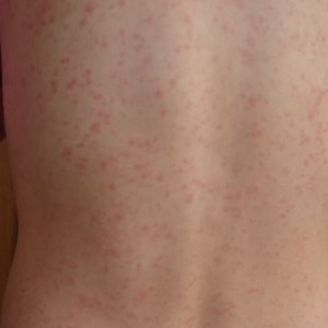 Що викликає появу алергії на шкірі і як безпомилково визначити алергічне прояв