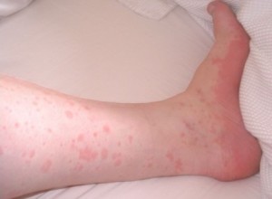 Mi okozza az allergia a bőrön, és hogyan kell pontosan meghatározni allergiás reakciók