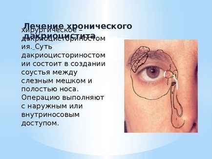 Dacryocystitis при възрастни - симптоми и лечение (снимка)