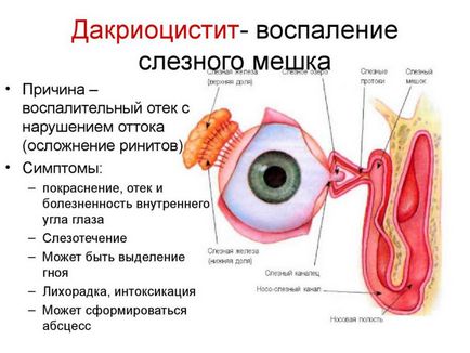 Dacryocystis la adulți - simptome și tratament (fotografie)