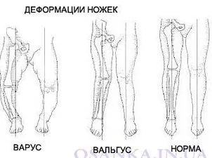 Deformările piciorului la copii - cauze, simptome și tratament