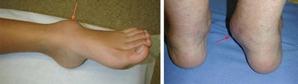 Deformarea artrozei articulației gleznei 1, 2 și 3 grade de simptome și tratament