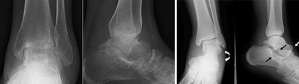 Deformarea artrozei articulației gleznei 1, 2 și 3 grade de simptome și tratament