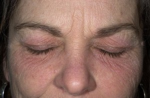 Dermatita sub ochi simptome, ce și cum să trateze, foto - vii sănătoși