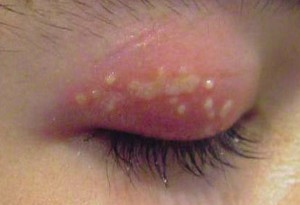 Dermatita sub ochi simptome, ce și cum să trateze, foto - vii sănătoși