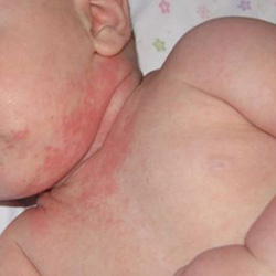 Dermatita in simptomele copilului si tratamentul cu medicamente populare