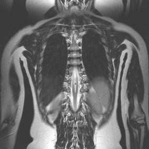 Diastematomieie a măduvei spinării - cauze de dezvoltare, manifestări și terapie