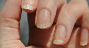 Ekcéma Nails okai, tünetei és kezelése