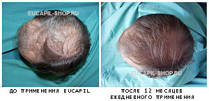 Eucapilus, cum funcționează eucapilul (eucapil), mecanismul de acțiune al eucapilului, un remediu pentru alopecie,