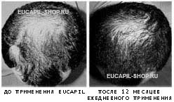 Eucapilus, cum funcționează eucapilul (eucapil), mecanismul de acțiune al eucapilului, un remediu pentru alopecie,