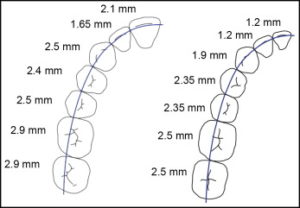 Evoluția sistemelor ortodontice, sistemelor de bretele - tipuri și tehnologii