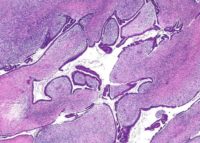 Fibroadenomul sânului - ce este acesta (foto)