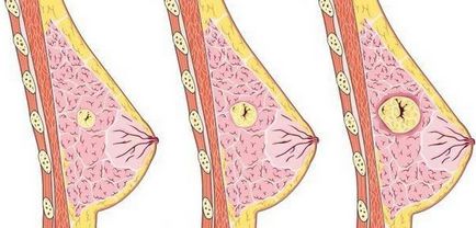 Fibroadenomul sânului - ce este acesta (foto)