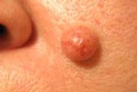 Nevus fibroepitelial - cauze, simptome, diagnostic și tratament