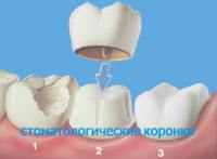 Fluoroza tratamentului dinților, motive de prevenire