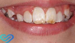 Флюороз зубів лікування, причини, як запобігти