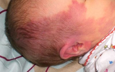 Hemangiomul la nou-născut este periculos, cauzele educației și metodele de tratament