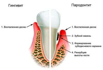 Гінгівіт причини, симптоми, лікування і профілактика