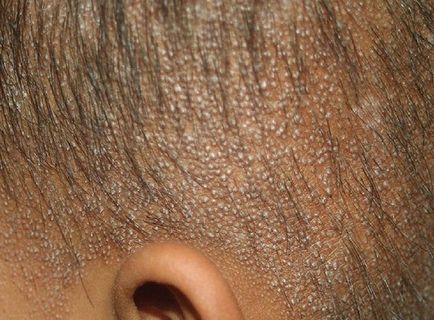 Гиперкератоз шкіри голови, обличчя, рук і ніг - зони локації, причини і лікування
