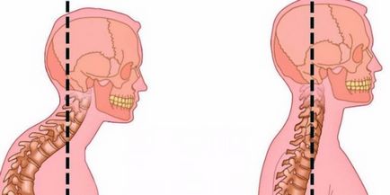Гіперлордоз (лордоз посилений) шийного відділу хребта симптоми, лікування, рекомендації