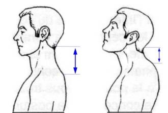 Hyperlordosis шийните прешлени причинява симптомите