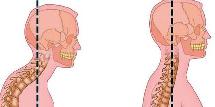 Hyperlordoza regiunii cervicale, simptome, tratament, exerciții