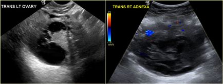 Tipuri histologice de cancer ovarian