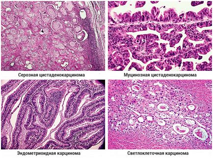 Tipuri histologice de cancer ovarian