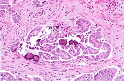 Tipuri histologice de cancer ovarian