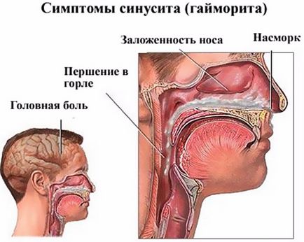 Sinuzită purulentă cauzează, simptome și tratament