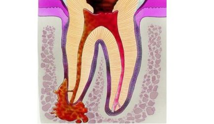 Гранулема зуба - що це таке і що робити причини, фото, симптоми і лікування захворювання