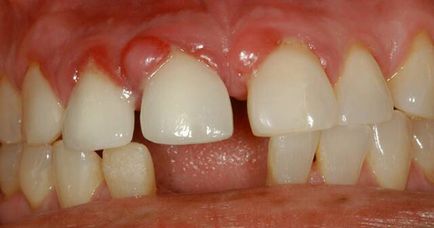 fogat granuloma - mi ez, és mit kell tenni, mert, fotó, tünetei és kezelése a betegség