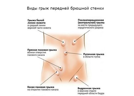 Hernia peretelui abdominal anterior - tratament, diagnostic și simptome ale bolii