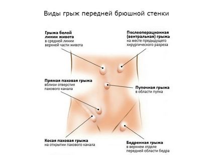 Грижа передньої черевної стінки - лікування, діагностика і симптоми захворювання