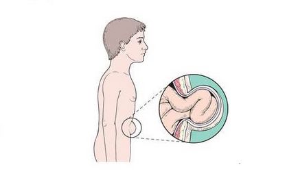 Hernia peretelui abdominal anterior provoacă apariția și simptomele