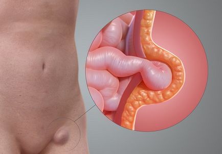 Hernia peretelui abdominal anterior provoacă apariția și simptomele