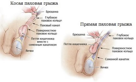 Hernia peretelui abdominal anterior provoacă apariția și simptomele