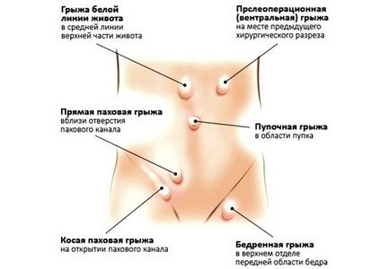 Hernia peretelui abdominal anterior provoacă apariția și simptomele