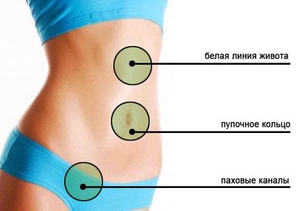 Hernia peretelui abdominal anterior provoacă apariția și simptomele