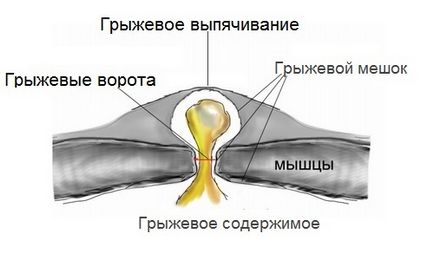 Hernia peretelui abdominal anterior provoacă apariția și simptomele