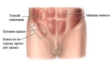 Hernia peretelui abdominal anterior provoacă apariția și simptomele