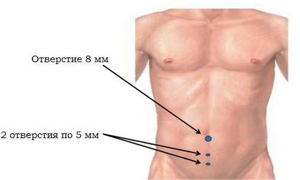 Hernia peretelui abdominal anterior provoacă apariția și simptomele