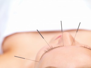 Acupunctura și nevralgia trigemenului